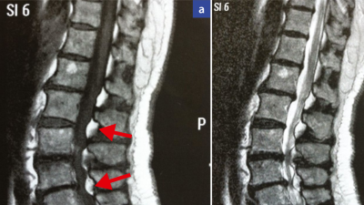 MRT-Befund bei spinaler epiduraler Lipomatose