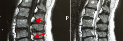 MRT-Befund bei spinaler epiduraler Lipomatose