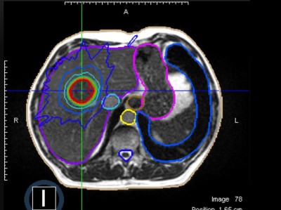 Körperstereotaxie einer Lebermetastase im Segment VIII am MR-LINAC