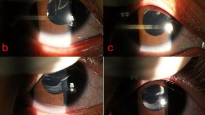 Image from case study_Slit-lamp biomicroscopy images in congenital lens dislocation syndrome