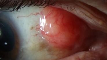 Image from review_Conjunctival lymphoma