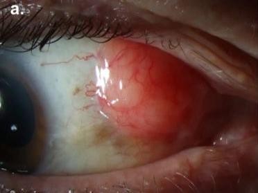 Image from review_Conjunctival lymphoma