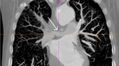 Chest CT scan of patient with granulomatosis with polyangiitis