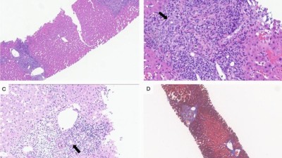 Image is the histological findings of a liver biopsy from a patient with persistently elevated alkaline phosphatase levels