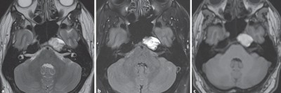 Cholesterolgranulom im MRT