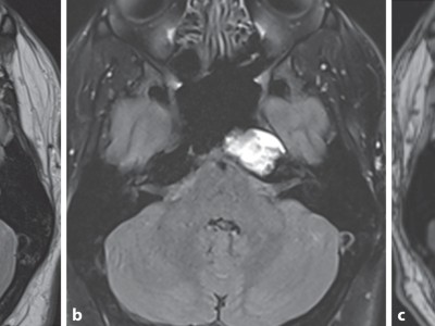 Cholesterolgranulom im MRT