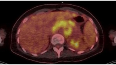 PET scan of multiple myeloma patient with extramedullary disease