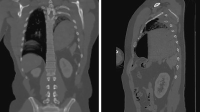  Traumatischer Enterothorax