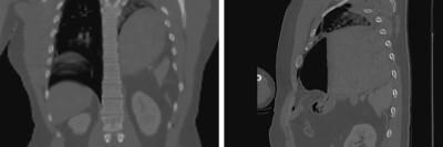  Traumatischer Enterothorax