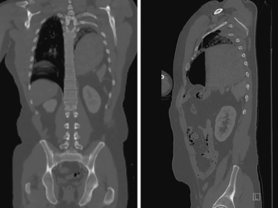  Traumatischer Enterothorax