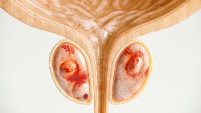 Leitthema: Familiäres und genetisches Risiko beim Prostatakarzinom – aktueller Stand