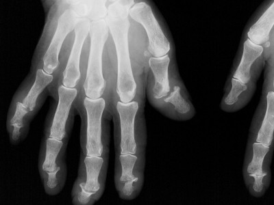 Röntgenbild betroffene Hände bei Psoriasis-Arthritis