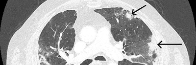 CT der Lunge mit Konsolidierungen (Pfeile) und Milchglastrübungen bei einer immunvermittelten Pneumonitis