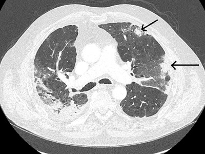 CT der Lunge mit Konsolidierungen (Pfeile) und Milchglastrübungen bei einer immunvermittelten Pneumonitis