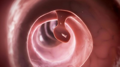 Image is a 3D rendered illustration of a colon polyp