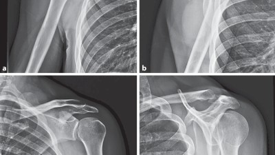 Bildgebung bei Schulterluxation