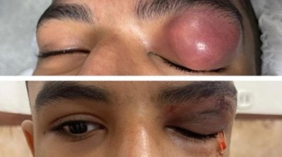 Image from case study_Patient with frontal osteomyelitis presenting as chronic preseptal abscess
