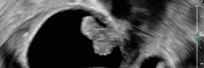 Ultraschall eines Adnextumors