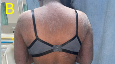 Erythroderma in patient with dermatomyositis