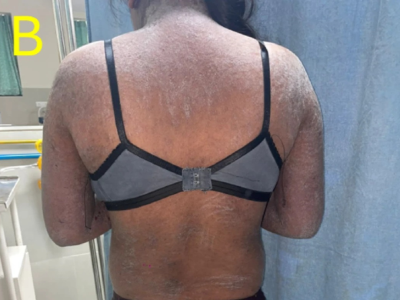 Erythroderma in patient with dermatomyositis