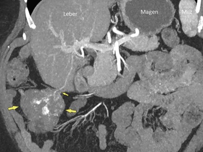 Kontrastmittelverstärkte MDCT des Abdomens einer 59-Jährigen