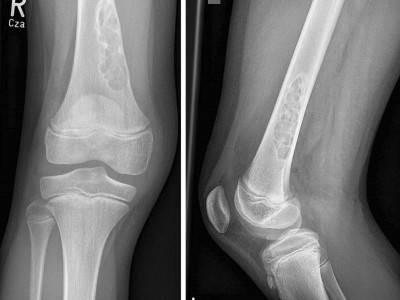 Röntgenaufnahme eines nicht ossifizierenden Fibroms 