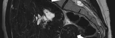 MRT des Beckens: Uterus und Ovarialtumoren