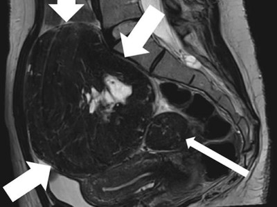 MRT des Beckens: Uterus und Ovarialtumoren