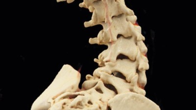 3D-Rekonstruktion der Wirbelsäule einer Patientin mit SMA Typ 2