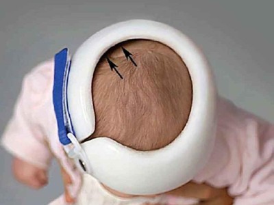 Lagerungsplagiozephalus