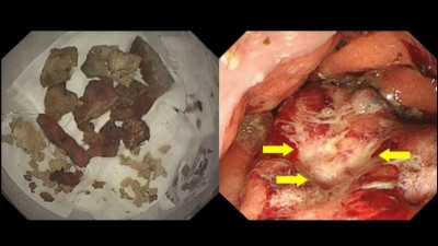 Images are a photograph of a fragment of sponge extracted from the esophagus and an endoscopic view of ulcer formation within the hernial sac