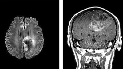 Image from case study_MRI brain scans of a patient with VEXAS syndrome-associated tumefactive demyelination