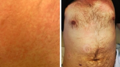 Stammbetonter, lachsfarbener Ausschlag bei 22-jährigem Patienten