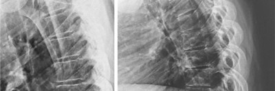 Röntgenaufnahme der Brustwirbelsäule