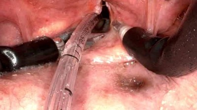 Intubation bei transoraler roboterassistierter Chirurgie