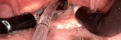 Intubation bei transoraler roboterassistierter Chirurgie