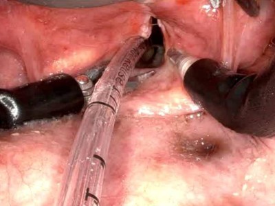 Intubation bei transoraler roboterassistierter Chirurgie
