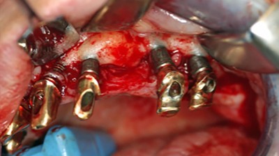 Klinische Abbildung: mehrere freigelegte enossale Implantate im Kieferkamm mit horizontalem Knochenabbau