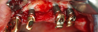 Klinische Abbildung: mehrere freigelegte enossale Implantate im Kieferkamm mit horizontalem Knochenabbau