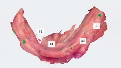 Digitales Ergebnisbild eines präoperativen Scans Unterkiefer: Zahnloser Kieferkamm. Von links nach rechts sind die Positionen 46, 44, 33, 36 markiert
