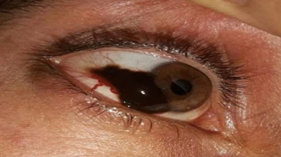Photograph of conjunctival malignant melanoma