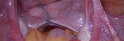 Uterosakralligamente 