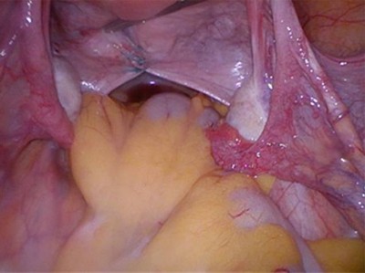 Uterosakralligamente 