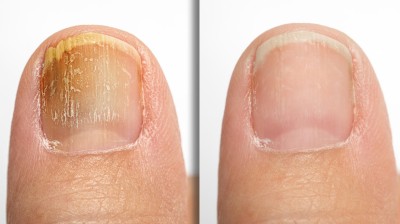 Vor und nach erfolgreicher Behandlung einer Pilzinfektion an den Zehen