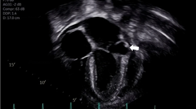 Transthoracic echocardiogram demonstrating an aneurysm located underneath the posterior leaflet of the mitral valve near the mitral valve atrioventricular junction 
