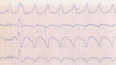 EKG bei ventrikulärer Tachykardie