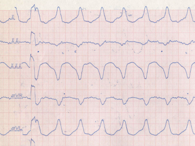 EKG bei ventrikulärer Tachykardie