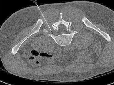 Computertomografie-gesteuerte periradikuläre Therapie auf Höhe von Lendenwirbelkörper 5/Sakralwirbelkörper 1 rechts