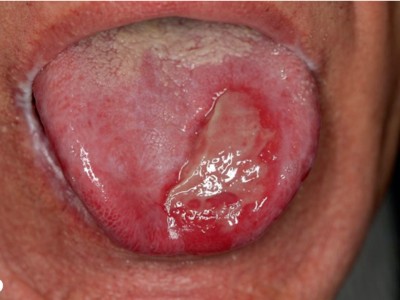 Ulzerative Form des oralen Lichen planus