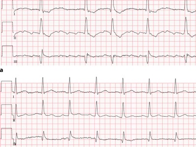EKG bei normofrequentem Vorhofflimmern